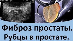 Фиброз простаты