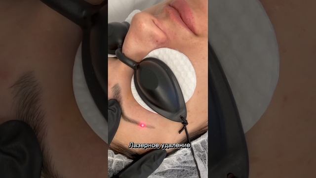 Лазерное удаление микроблейдинга. Хвосты бровей, До и После смотреть онлайн
