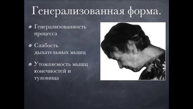 Миастения. Myasthenia Gravis.