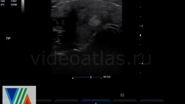 Гиперэхогенный узел щитовидной железы смотреть онлайн