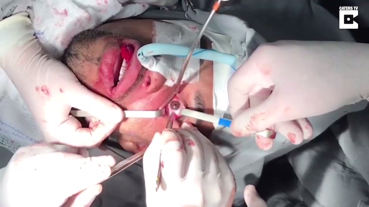 Как проходит операция на глазах смотреть онлайн