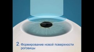 Коррекция зрения ФРК (фоторефракционная кератэктомия)