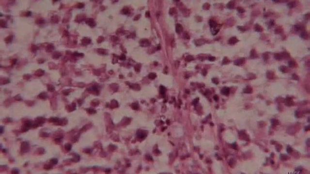 Seminoma