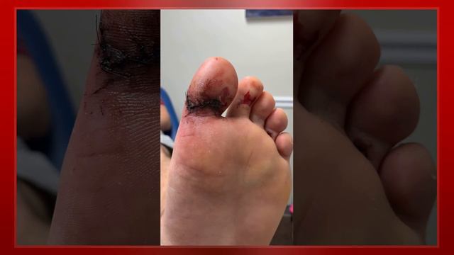 Degloving смотреть онлайн