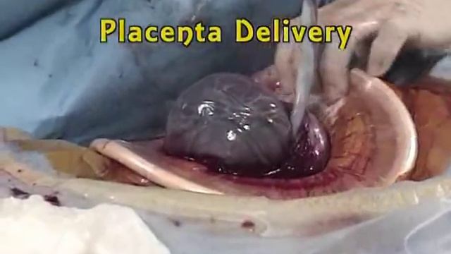 C-Section with the Mobius® elastic retractor (1) смотреть онлайн