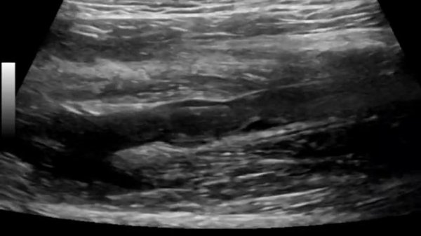 флотирующий тромб МБВ