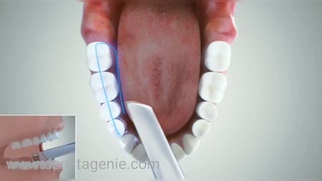 bridge scan path with Launca intraoral scanner смотреть онлайн