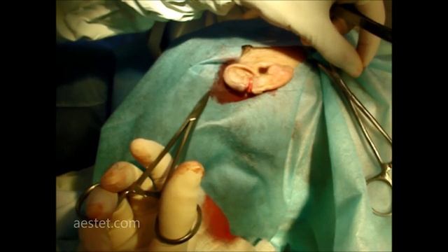 Ear Defect Repair // Как Правильно Зашить Ухо