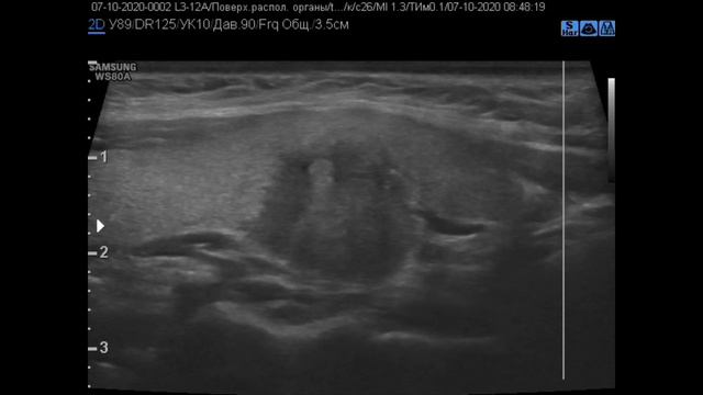 ti rads 4 5 смотреть онлайн