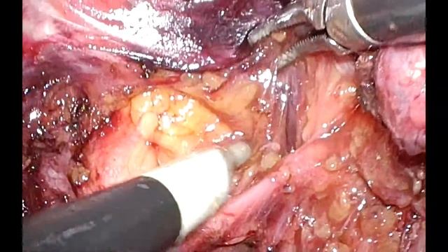 Laparoscopic pelvic lymph node dissection for rectal cancer смотреть онлайн