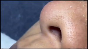 Чёрные точки выдавливание на лице  /  выдавливание прыщей / черноголовые прыщи / фурункул | asmr