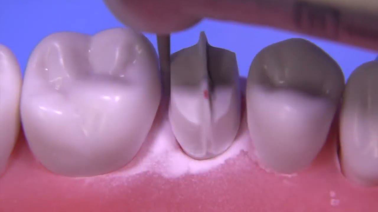 Препарирование премоляра под металлокерамическую коронку с использованием техники T-prep