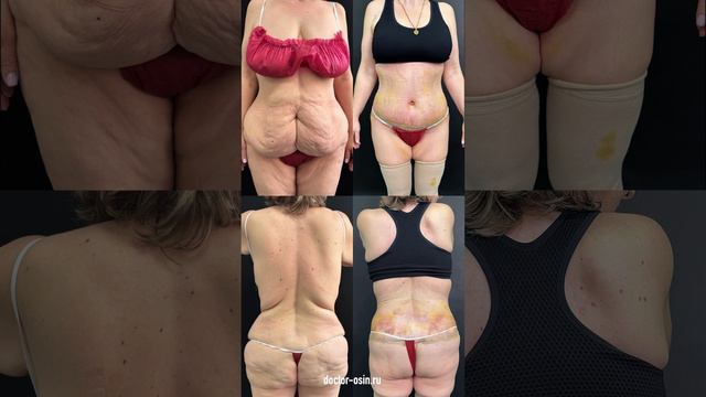 Убрал огромный живот и восстановил тело после 3х родов #бодилифтинг