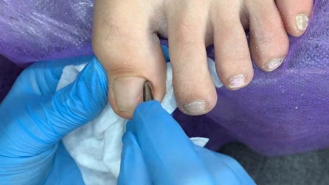 ПЕРЕНОСИЛА ГЕЛЬ-ЛАК. Обработка ОНИХОЛИЗИСА. ПЕДИКЮР аппаратом. ОНИХОЛИЗИС смотреть онлайн