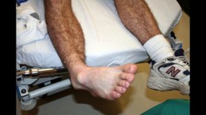 Переломы лодыжек, всё что нужно знать за 10 минут