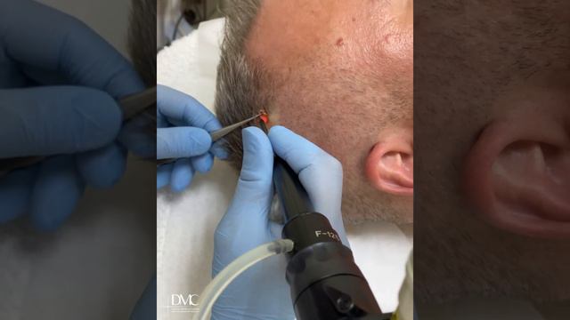 Лазерное удаление Невуса на коже головы. Как проходит удаление родинок на голове в Damasclinic.ru смотреть онлайн