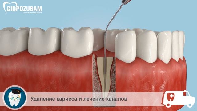 Восстановление зуба. Наращивание зуба на штифте