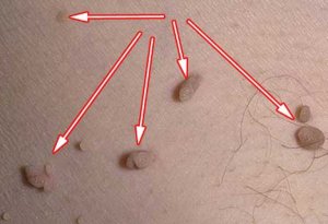 От чего на теле появляются папилломы.