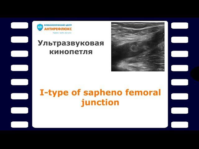 I-type of sapheno femoral junction смотреть онлайн