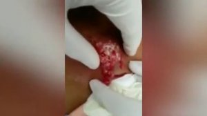 Прищи, Фурункул