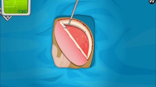 Challenging Journey to a Successful Epilepsy Surgery in Operate Now | Gameplay Recording смотреть онлайн