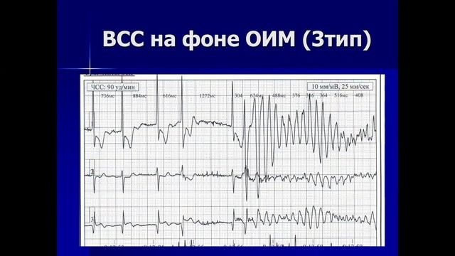 31-03-22 Куприянова АВ Диагностика раних осложнений инфаркта миокарда.mp4