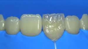 Восстановление переднего зуба за 4 минуты.Прямая реставрация переднего зуба