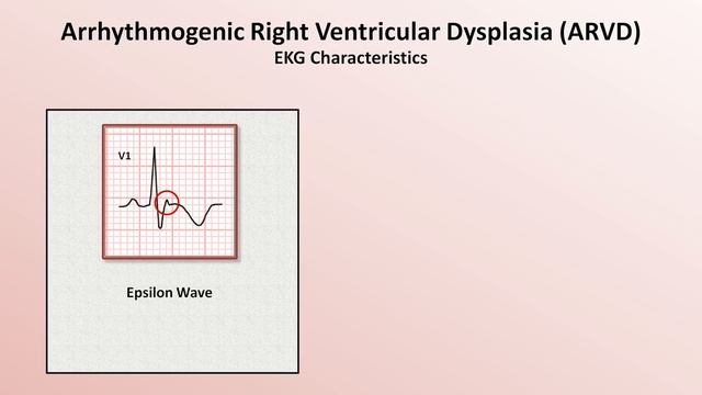 Advanced EKGs - Sudden Cardiac Death (Hypertrophic cardiomyopathy, ARVD, Brugada syndrome, and CPVT смотреть онлайн