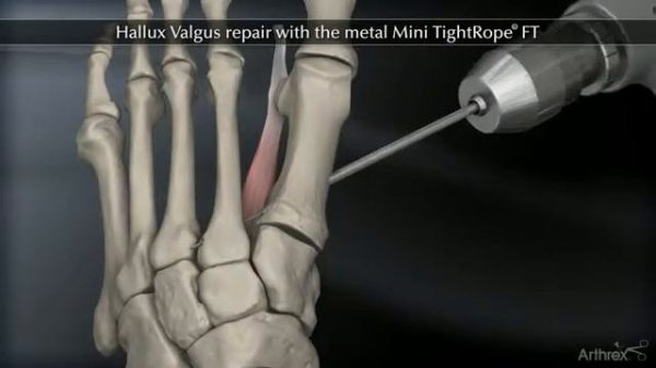 Hallux Valgus Mini TightRope