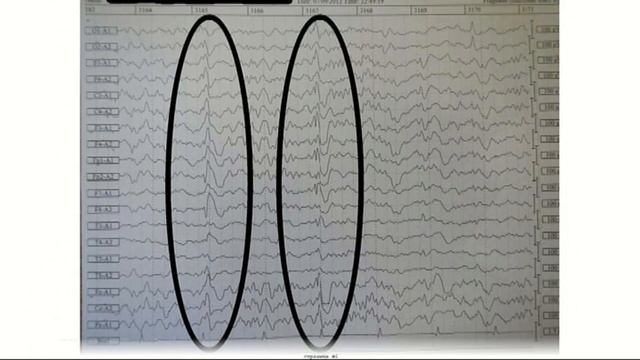 Эпилепсия и сон смотреть онлайн