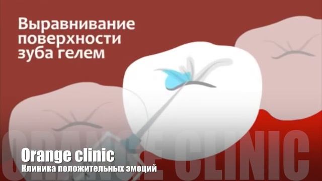 Герметизация фиссур orange смотреть онлайн
