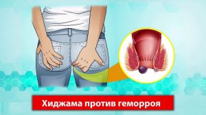 Авиценна Хиджама при Геморрое , как лечить геморрой , геморрой бывает внешний и внутренний