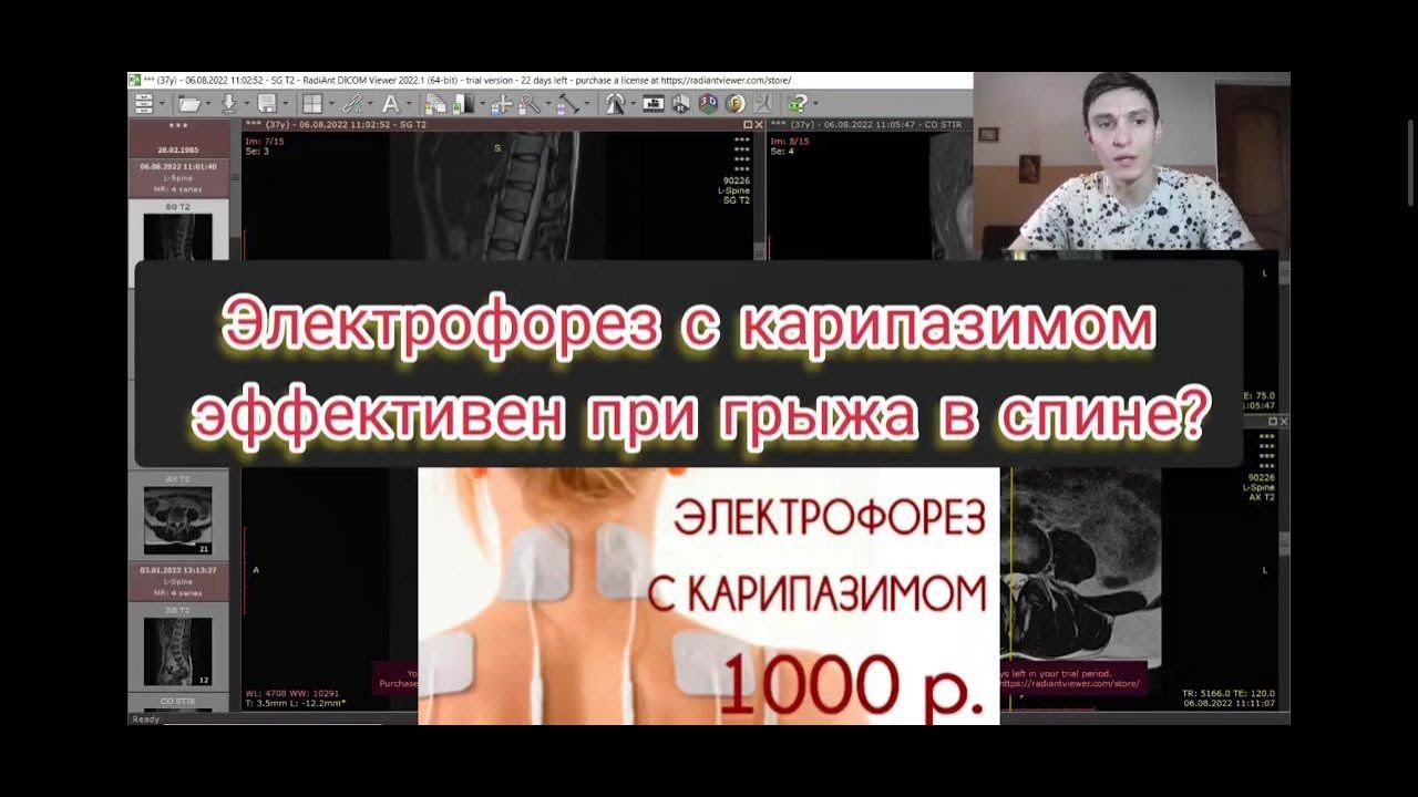 Названа эффективная процедура для позвоночника. | Карипазин\карипаин с электрофорезом. смотреть онлайн