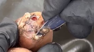 Jigger digging Zablon's few fat jiggers - subscribe @.net for full video