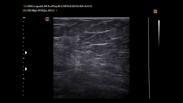 Рак молочной железы (23-1-17) смотреть онлайн