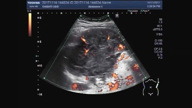 Ultrasound Video showing Hypoechoic splenic lesions. смотреть онлайн