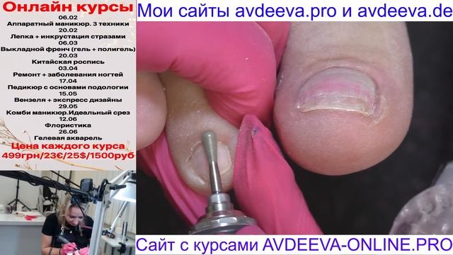 ПЕДИКЮР ПРИ ДИАБЕТЕ ОНЛАЙН. ВРОСШИЙ НОГОТЬ. Виктория Авдеева смотреть онлайн