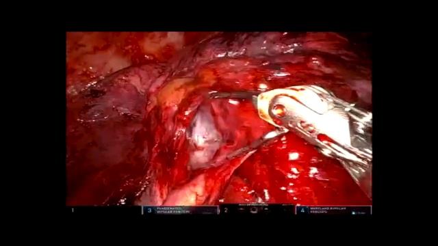 Uniportal robotic right upper lobectomy and lymph node dissection in UK смотреть онлайн