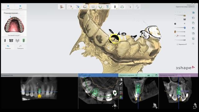 ImplantStudio SurgicalGuide