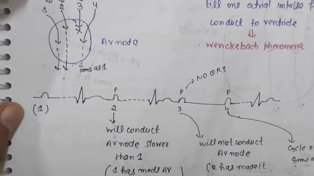 First/second/Third degree heart block | Cardiac arrhythmia in hindi | Av block | #2 смотреть онлайн