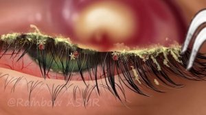 ASMR Multiple Contact Lens & Maggot Removal | Dirty Eye Deep Cleaning Animation