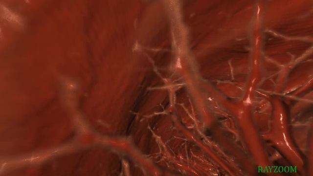Lymph node in the lung. Virtual endoscopy. Reconstruction смотреть онлайн