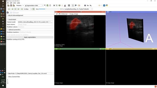 Real-time ultrasound AI segmentation and volume reconstruction смотреть онлайн