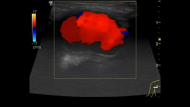 шишка под мышкой смотреть онлайн