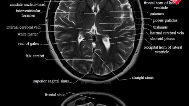 brain Mri axial section anatomy multiple axial section T2 weighted image смотреть онлайн