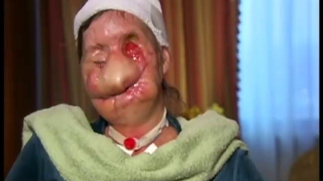 Chimp Attack Survivor Shows Her Face смотреть онлайн