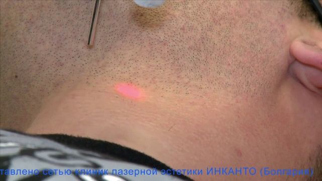 Лазерная эпиляция (часть 2)