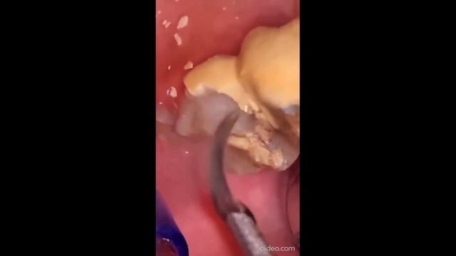 удаления зубного камня смотреть на ютуб _tartar removal watch on youtube смотреть онлайн
