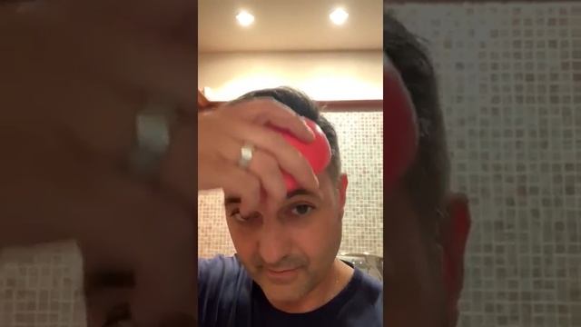 Dr Serkan Aygin - отзыв на пересадку волос в Турции от итальянца (1) смотреть онлайн