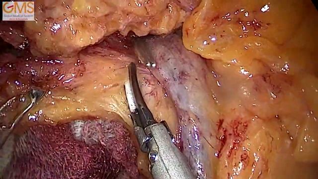 Laparoscopic right hemicolectomy with D3 lymph node dissection смотреть онлайн